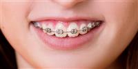 Niềng răng khớp cắn sâu bao nhiêu tiền?
