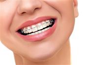 Giá niềng răng bao nhiêu tại Hà Nội?
