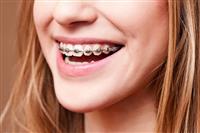 Niềng răng cửa thưa mất bao nhiêu tiền?