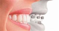 Niềng răng thưa 1 hàm giá bao nhiêu?