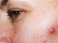 7 cách chữa mụn nhọt sưng to tương đối hiệu quả