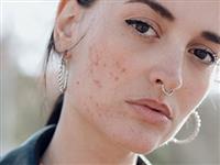 Cách trị thâm mụn nặng: Giải pháp chăm sóc da phổ biến hiện nay