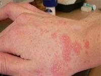 Các loại thuốc bôi viêm da cơ địa phổ biến có thực sự hiệu quả ?