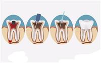 Dụng cụ điều trị tủy răng