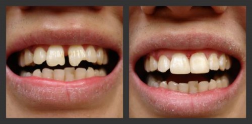 Chi phí trám răng bao nhiêu tiền