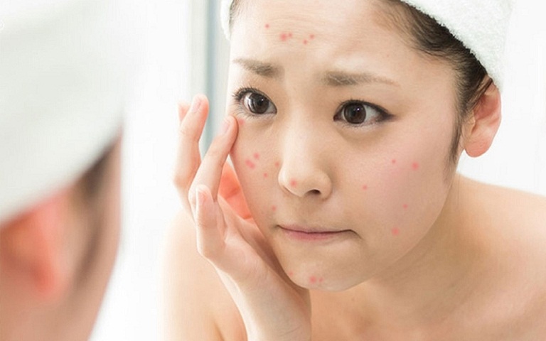 Địa chỉ trị mụn chuẩn y khoa giá “sinh viên”