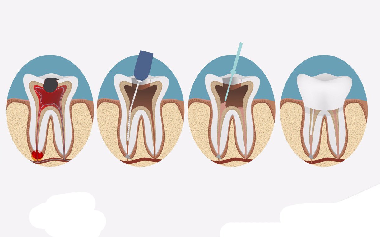 Dụng cụ điều trị tủy răng