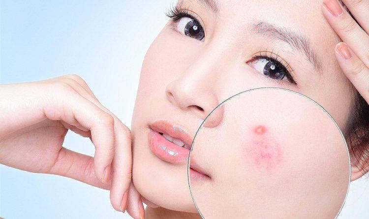 Điều cần biết về mụn viêm và cách điều trị