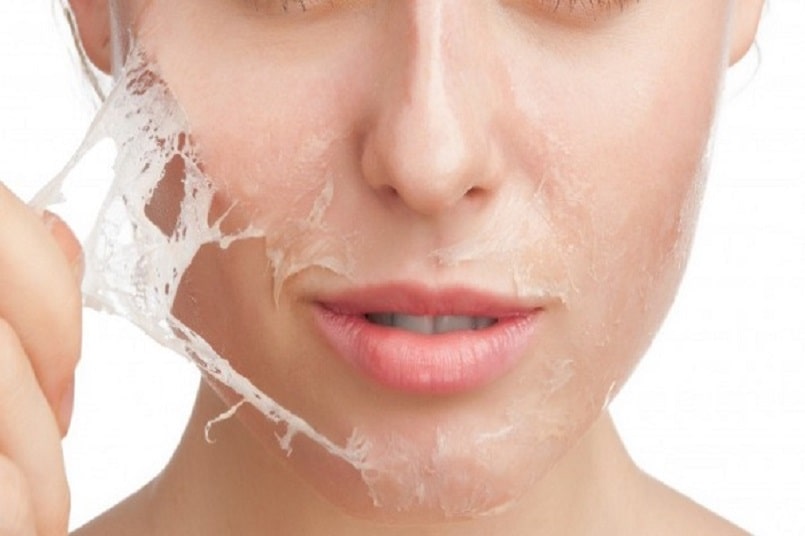 Điều cần biết về mụn viêm và cách điều trị