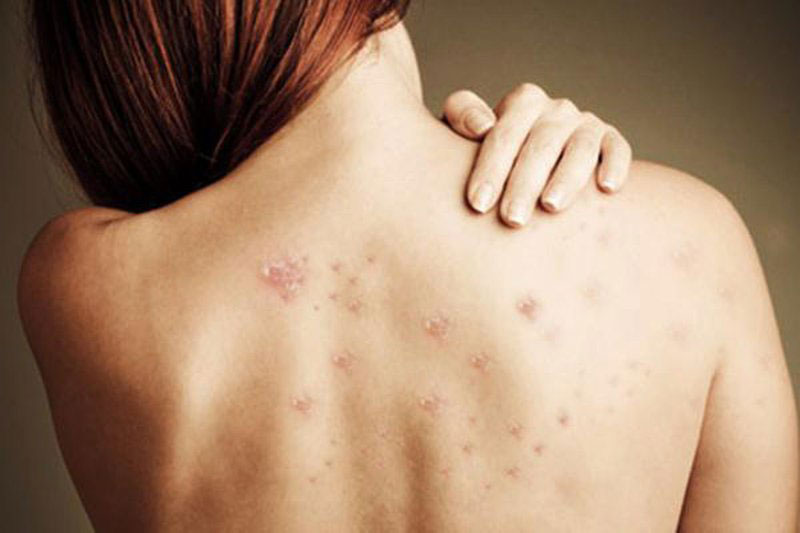 Cách trị mụn lưng cấp tốc tại nhà chỉ trong 1 tuần